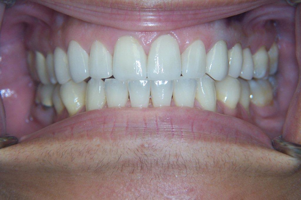 after - porcelain veneer - dr safferstein