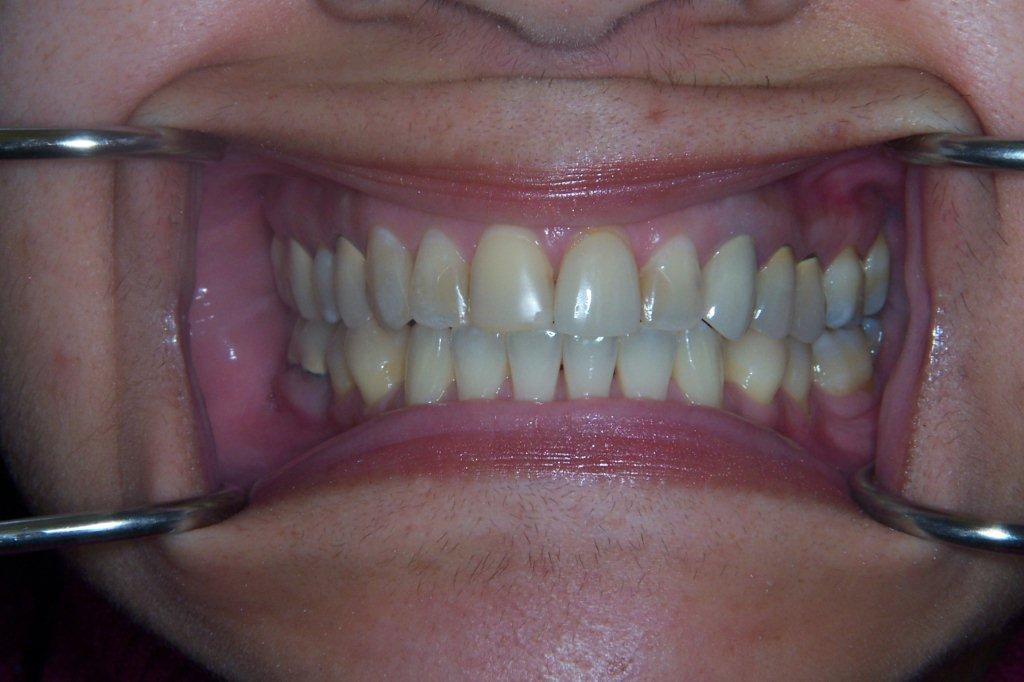 before - porcelain veneer - dr safferstein