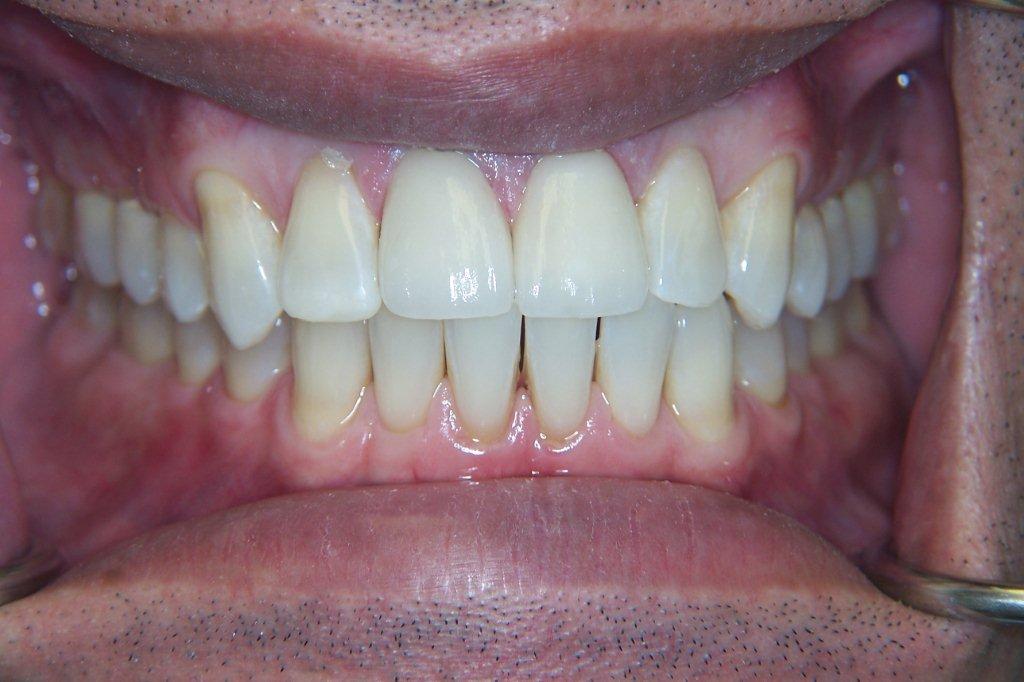 before - porcelain veneer - dr safferstein