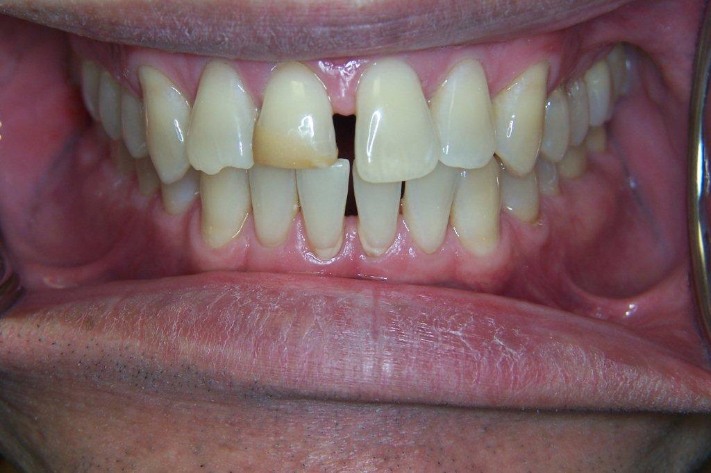 before - porcelain veneer - dr safferstein